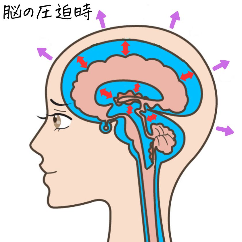 脳脊髄液の圧迫時