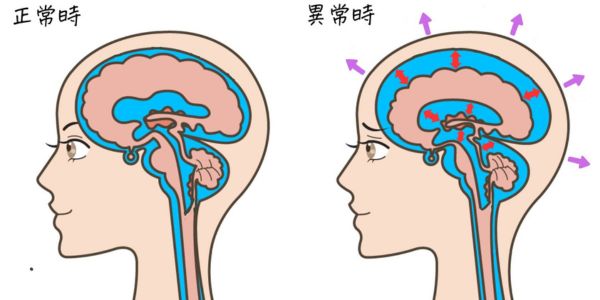 脳脊髄液の正常時と異常時